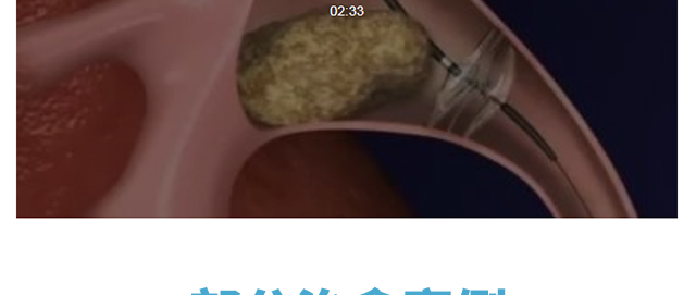 钬激光