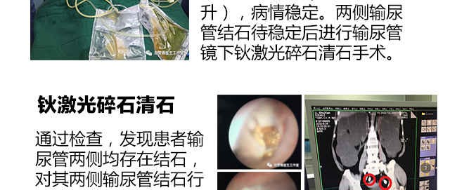 钬激光